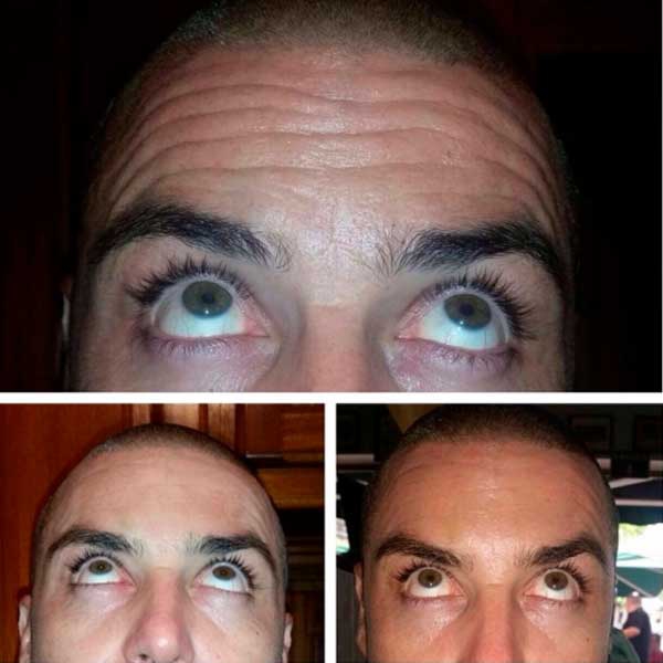 Tratamientos para la frente