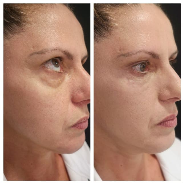 Tratamiento para ojeras