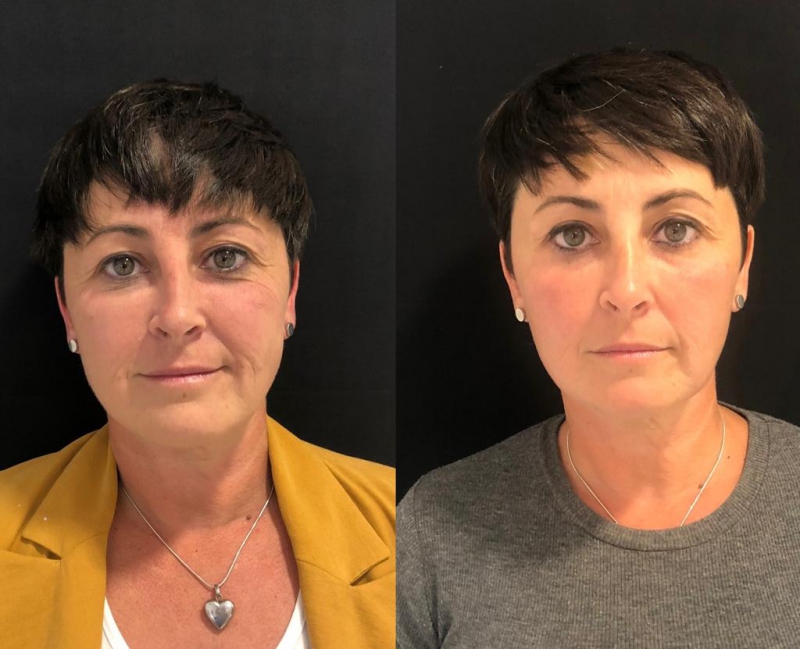 Tratamientos para las arrugas