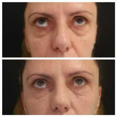Tratamiento para ojeras